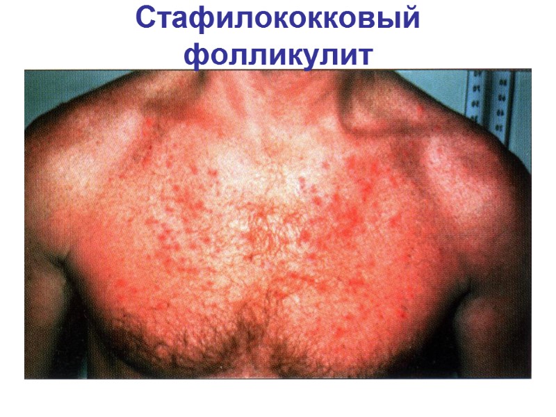 Стафилококковый фолликулит